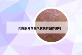 長期服用白癜風(fēng)膠囊有副作用嗎...