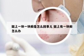 腿上一塊一塊癬是怎么回事兒 腿上有一塊癬怎么辦