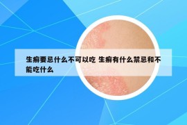 生癬要忌什么不可以吃 生癬有什么禁忌和不能吃什么