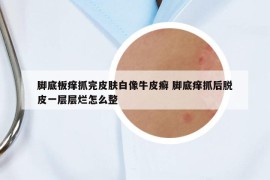 腳底板癢抓完皮膚白像牛皮癬 腳底癢抓后脫皮一層層爛怎么整