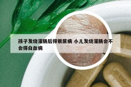 孩子發(fā)燒灌腸后得銀屑病 小兒發(fā)燒灌腸會不會得白血病