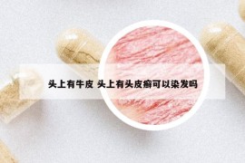 頭上有牛皮 頭上有頭皮癬可以染發(fā)嗎