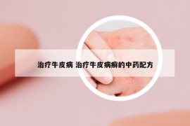 治療牛皮病 治療牛皮病癬的中藥配方