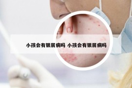 小孩會有銀屑病嗎 小孩會有銀屑病嗎