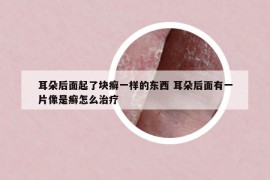 耳朵后面起了塊癬一樣的東西 耳朵后面有一片像是癬怎么治療