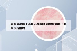 副銀屑病臉上會長小疙瘩嗎 副銀屑病臉上會長小疙瘩嗎
