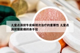 兒童點(diǎn)滴狀牛皮癬初次治療的重要性 兒童點(diǎn)滴狀銀屑病終身不犯