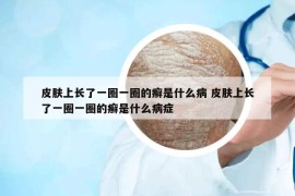 皮膚上長了一圈一圈的癬是什么病 皮膚上長了一圈一圈的癬是什么病癥