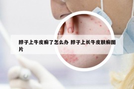脖子上牛皮癬了怎么辦 脖子上長(zhǎng)牛皮膚癬圖片