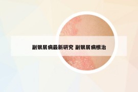 副銀屑病最新研究 副銀屑病根治