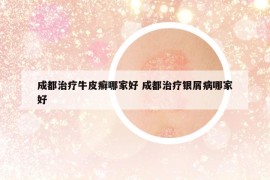 成都治療牛皮癬哪家好 成都治療銀屑病哪家好