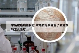掌跖膿皰病能自愈 掌跖膿皰病自愈了會復(fù)發(fā)嗎怎么治療