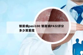 銀屑病pasi100 銀屑病PASI評分多少算重度