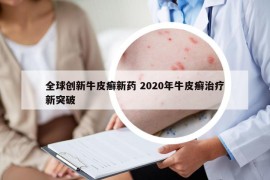 全球創(chuàng)新牛皮癬新藥 2020年牛皮癬治療新突破