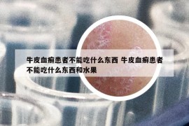 牛皮血癬患者不能吃什么東西 牛皮血癬患者不能吃什么東西和水果