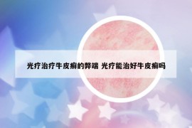 光療治療牛皮癬的弊端 光療能治好牛皮癬嗎