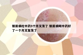銀屑病吃中藥9個月又發(fā)了 銀屑病喝中藥好了一個月又復發(fā)了