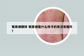銀屑病模樣 銀屑病是什么樣子的有沒有圖片?