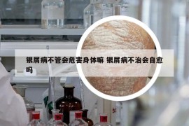 銀屑病不管會(huì)危害身體嘛 銀屑病不治會(huì)自愈嗎