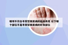 哪項不符合尋常型銀屑病的臨床表現 以下哪個部位不是尋常型銀屑病的好發(fā)部位
