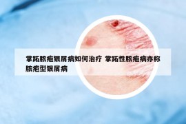 掌跖膿皰銀屑病如何治療 掌跖性膿皰病亦稱膿皰型銀屑病