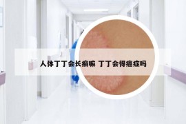 人體丁丁會(huì)長(zhǎng)癬嘛 丁丁會(huì)得癌癥嗎