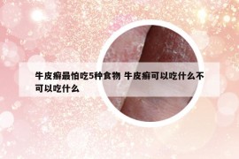 牛皮癬最怕吃5種食物 牛皮癬可以吃什么不可以吃什么