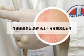 牛皮皮癬怎么,治療 頭上牛皮皮癬怎么治療