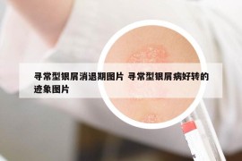 尋常型銀屑消退期圖片 尋常型銀屑病好轉(zhuǎn)的跡象圖片