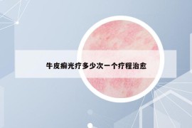 牛皮癬光療多少次一個療程治愈