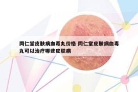 同仁堂皮膚病血毒丸價格 同仁堂皮膚病血毒丸可以治療哪些皮膚病