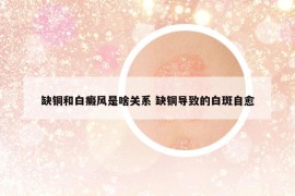 缺銅和白癜風(fēng)是啥關(guān)系 缺銅導(dǎo)致的白斑自愈