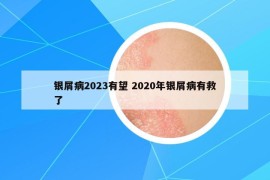 銀屑病2023有望 2020年銀屑病有救了