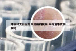 辣椒和大蒜治療牛皮癬的視頻 大蒜治牛皮鮮病嗎