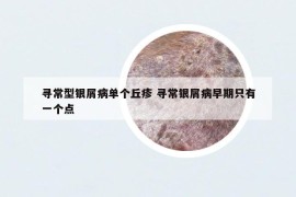 尋常型銀屑病單個(gè)丘疹 尋常銀屑病早期只有一個(gè)點(diǎn)