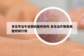青島專治牛皮癬的醫(yī)院有嗎 青島治療銀屑病醫(yī)院排行榜