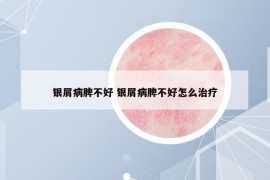銀屑病脾不好 銀屑病脾不好怎么治療