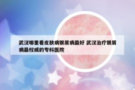 武漢哪里看皮膚病銀屑病最好 武漢治療銀屑病最權(quán)威的?？漆t(yī)院