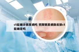 ct能確診銀屑病嗎 初期銀屑病做皮膚ct能確定嗎