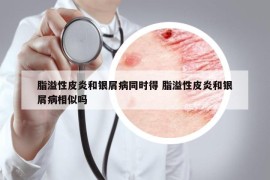 脂溢性皮炎和銀屑病同時(shí)得 脂溢性皮炎和銀屑病相似嗎