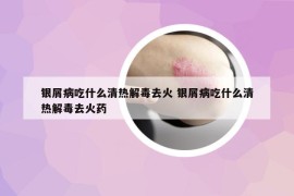 銀屑病吃什么清熱解毒去火 銀屑病吃什么清熱解毒去火藥