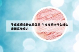 牛皮皮癬吃什么維生素 牛皮皮癬吃什么維生素提高免疫力