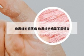 吹風機對銀屑病 吹風機治病是不是謠言
