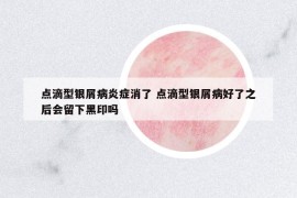 點(diǎn)滴型銀屑病炎癥消了 點(diǎn)滴型銀屑病好了之后會(huì)留下黑印嗎