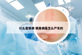 什么是銀病 銀屬病是怎么產(chǎn)生的