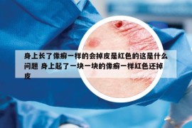 身上長(zhǎng)了像癬一樣的會(huì)掉皮是紅色的這是什么問(wèn)題 身上起了一塊一塊的像癬一樣紅色還掉皮