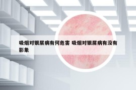 吸煙對(duì)銀屑病有何危害 吸煙對(duì)銀屑病有沒有影象