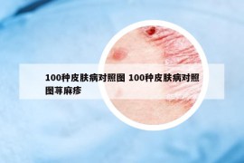 100種皮膚病對(duì)照?qǐng)D 100種皮膚病對(duì)照?qǐng)D蕁麻疹