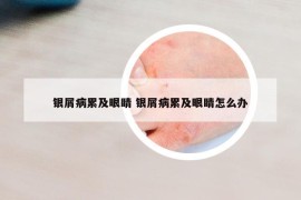 銀屑病累及眼睛 銀屑病累及眼睛怎么辦