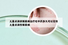 兒童點滴狀銀屑病治療吃中藥多久可以見效 兒童點滴性銀屑病